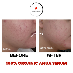 Anua Azelaic Acid 10 Hyaluron Redness Soothing Serum