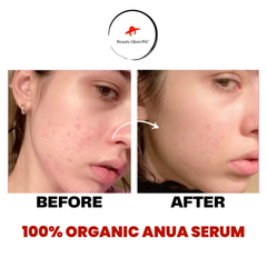 Anua Azelaic Acid 10 Hyaluron Redness Soothing Serum